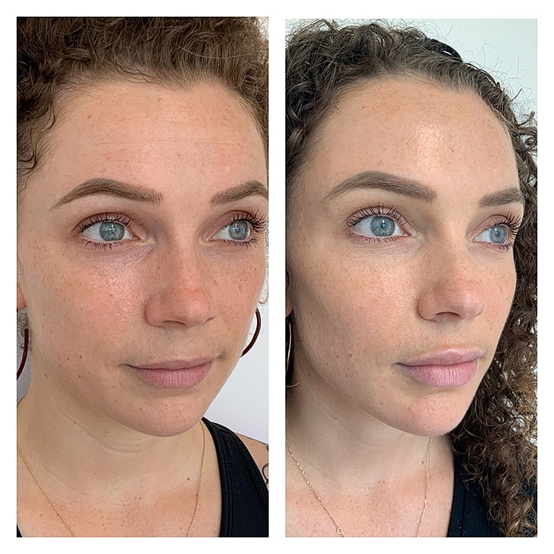 Dermal Filler Before & After