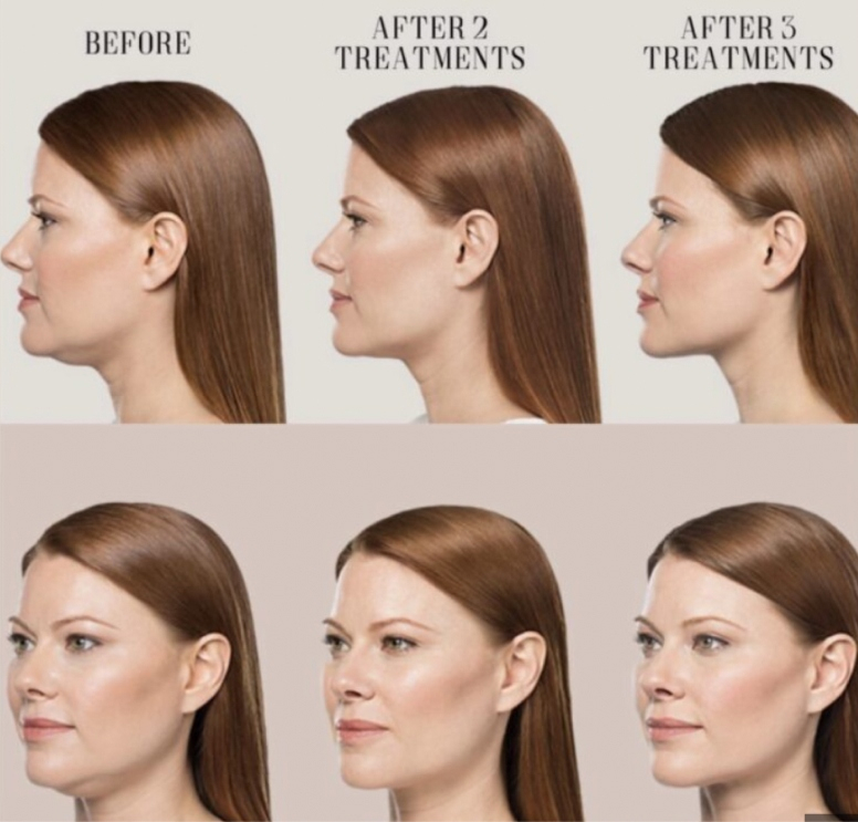 Oakland Kybella patient before and after