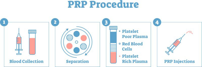 Oakland PRP procedure steps