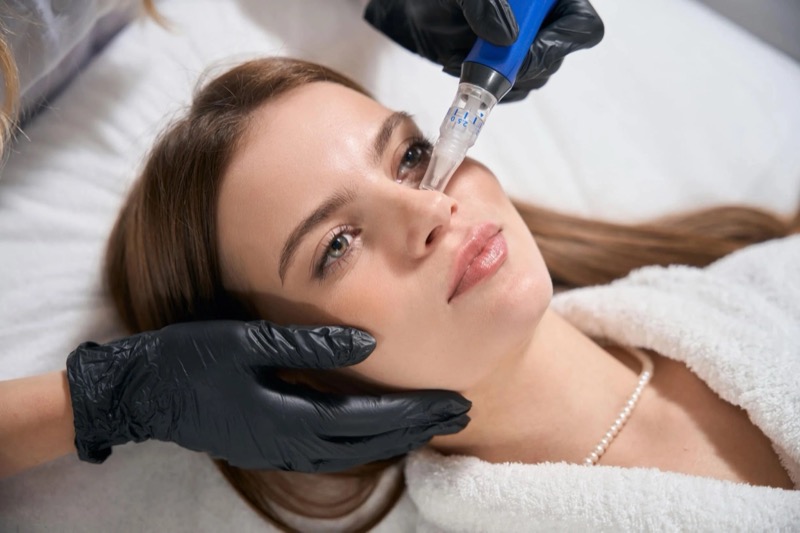 Oakland SkinPen Microneedling model closeup