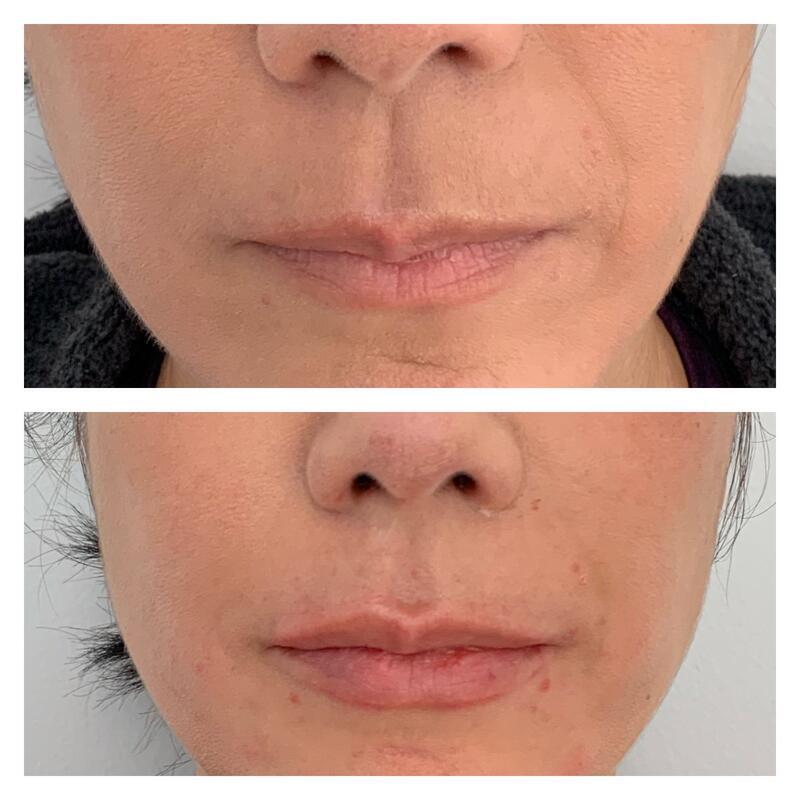 Lip Fillers Before & After Image