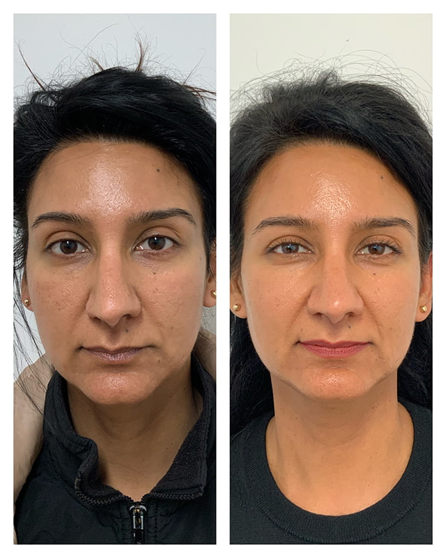 PRP Microneedling Before & After Image