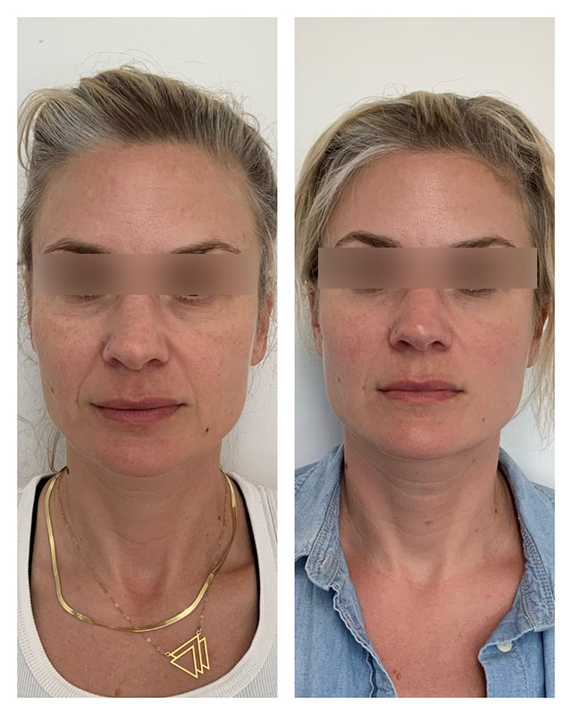 Sculptra Before & After Image