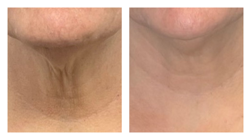 Potenza RF Microneedling Before & After Image