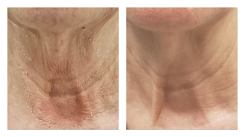 Potenza RF Microneedling Before & After Image