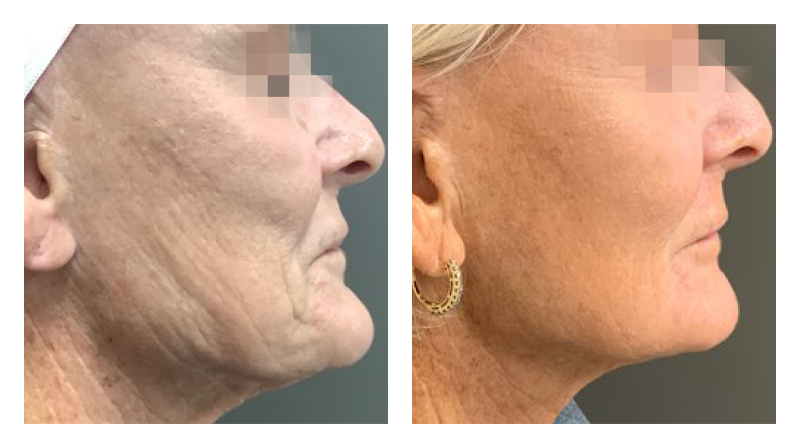 Potenza RF Microneedling Before & After Image