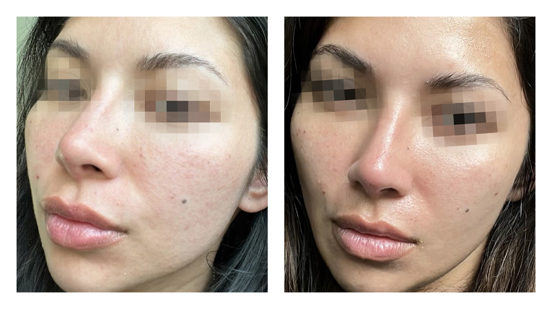 Potenza RF Microneedling Before & After Image