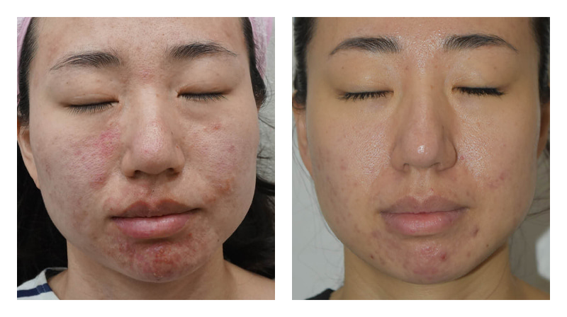 Potenza RF Microneedling Before & After Image