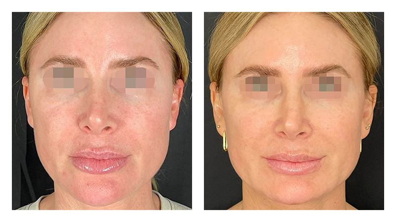 Potenza RF Microneedling Before & After Image